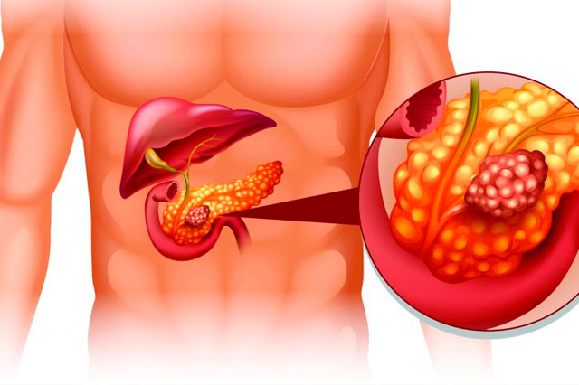 Dr Paulo Ramalho - Câncer de pâncreas